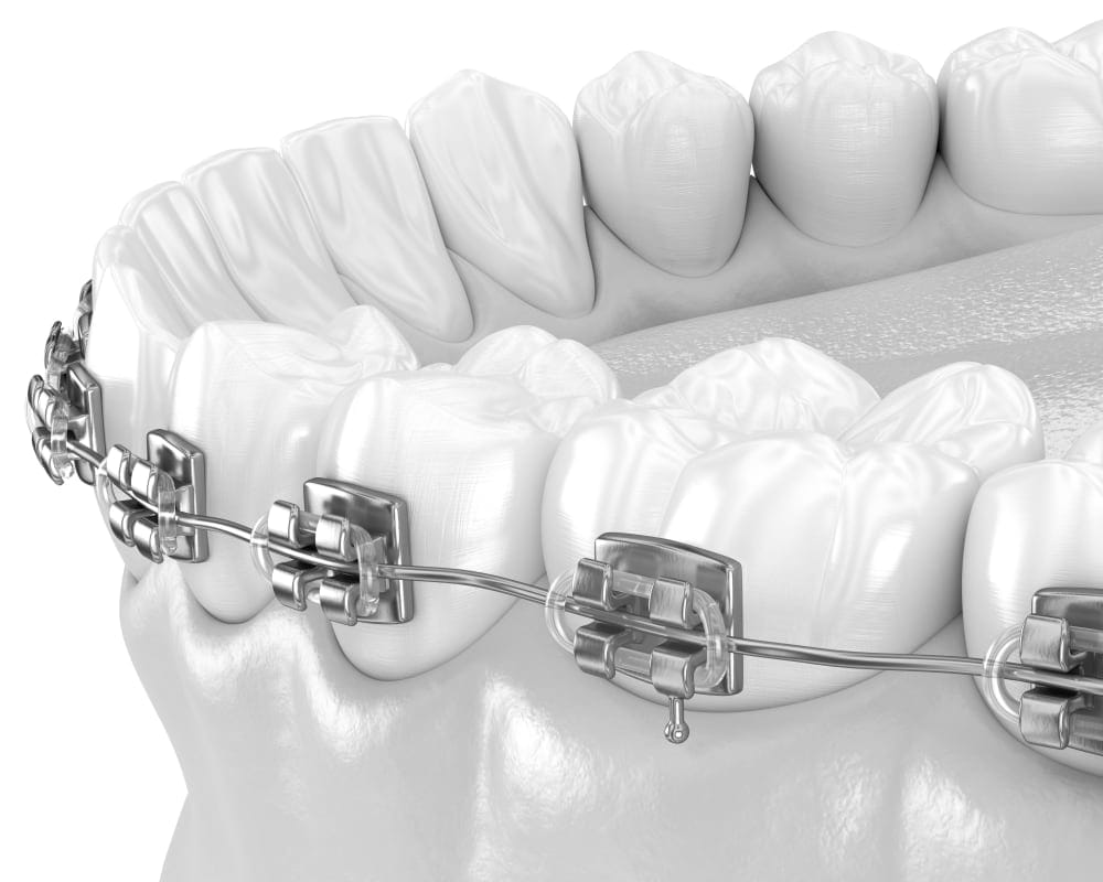 Traditional Metal Braces, North Vancouver Orthodontist