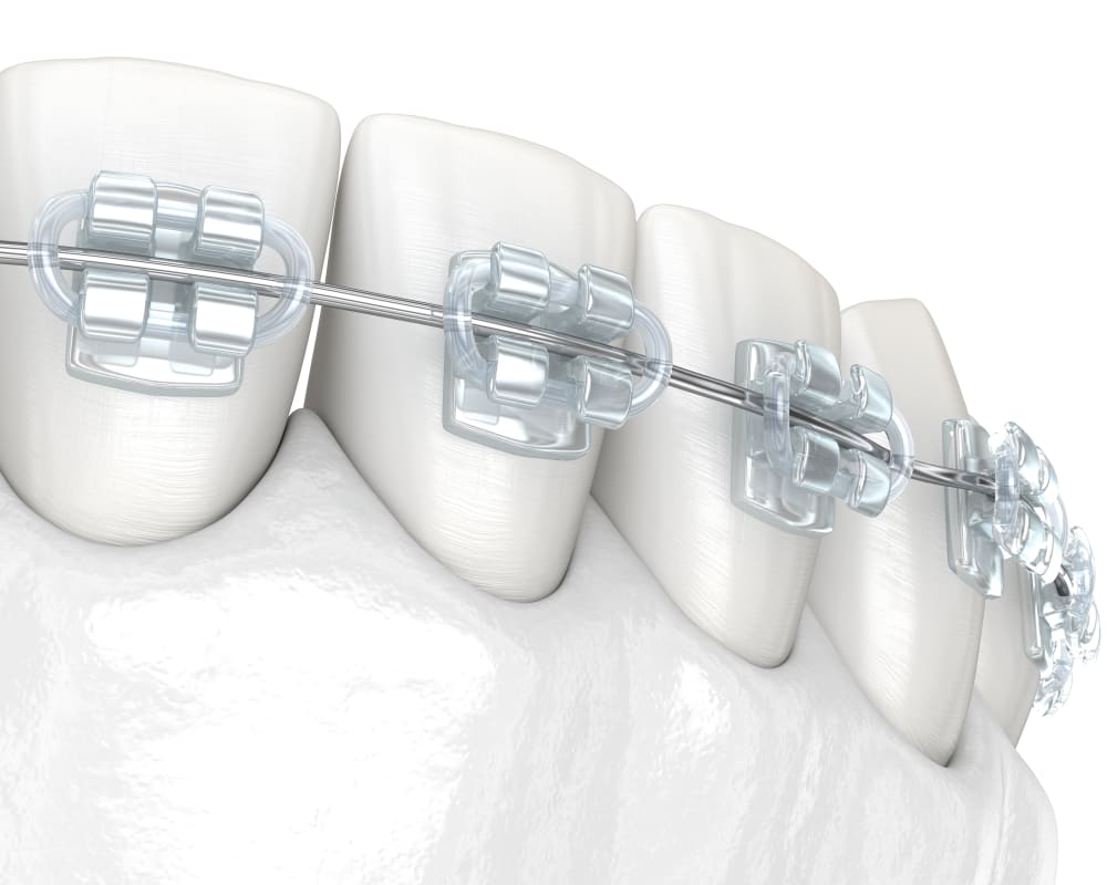 Translucent Braces, North Vancouver Orthodontist