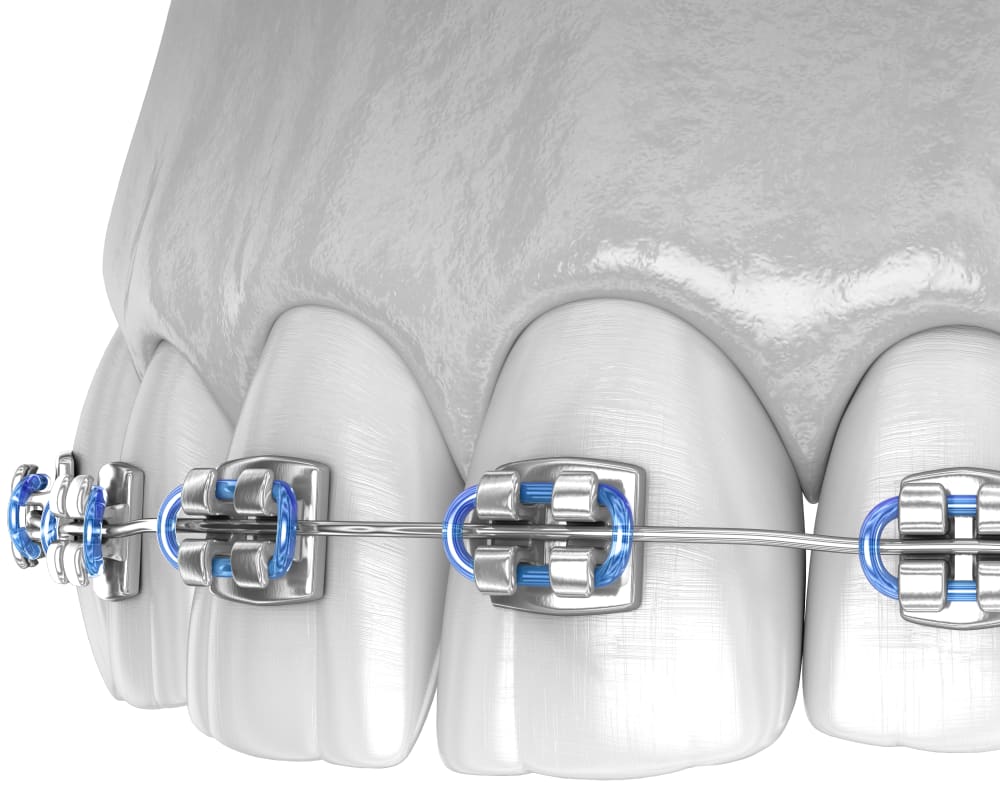 Coloured Braces, North Vancouver Orthodontist