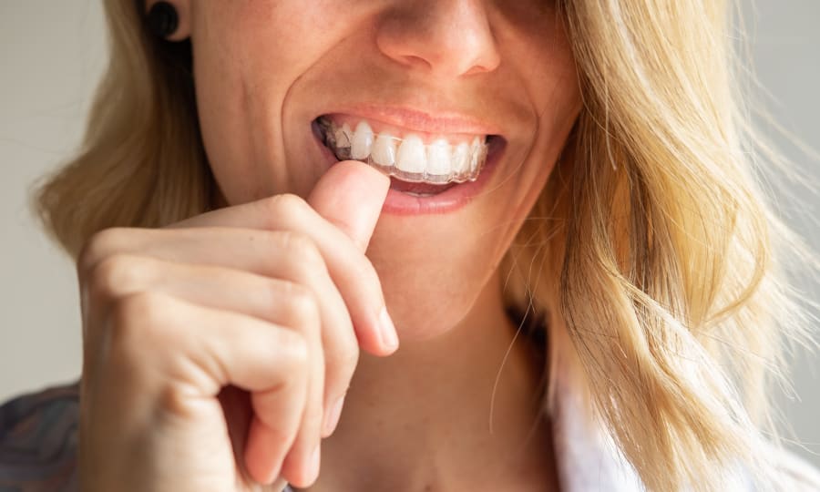 Low-Profile Aesthetics of Clear Aligners at Westview Orthodontics