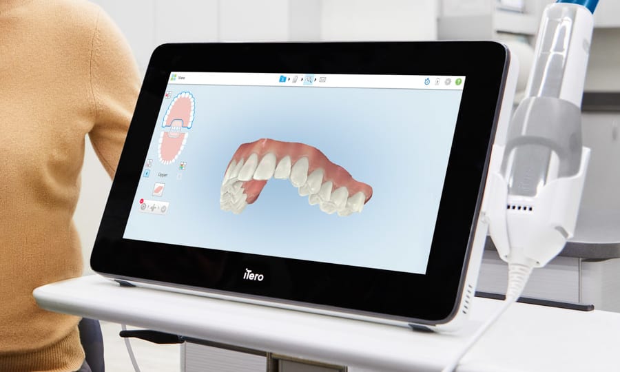Digital Impressions with iTero at Westview Orthodontics