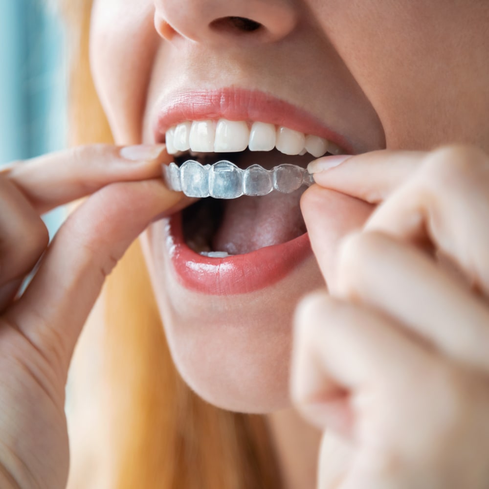 Orthodontic Retainers, North Vancouver