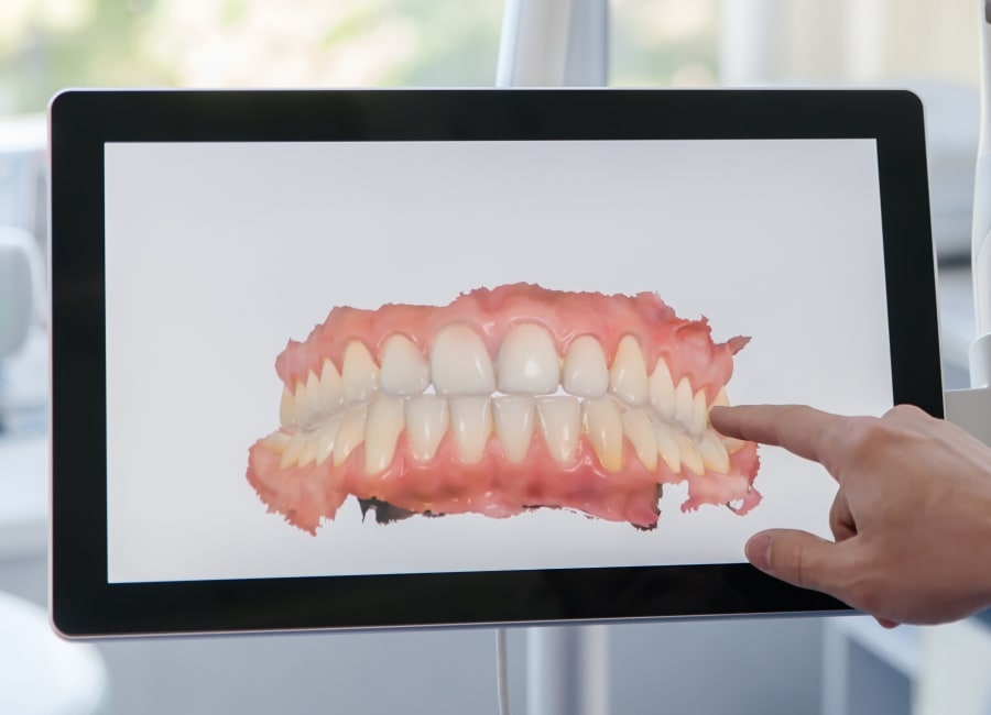 iTero Intraoral Scanner, North Vancouver Orthodontist